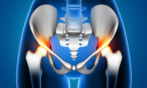Hip Replacement