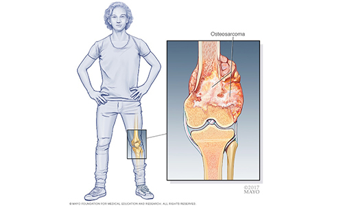 Orthopedic Cancer Surgery