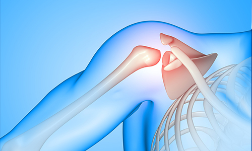 Shoulder Replacement